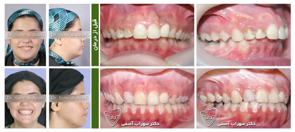 قبل و بعد درمان ارتودنسی