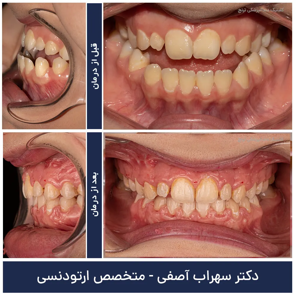 قبل و بعد درمان ارتودنسی با دکتر سهراب آصفی 