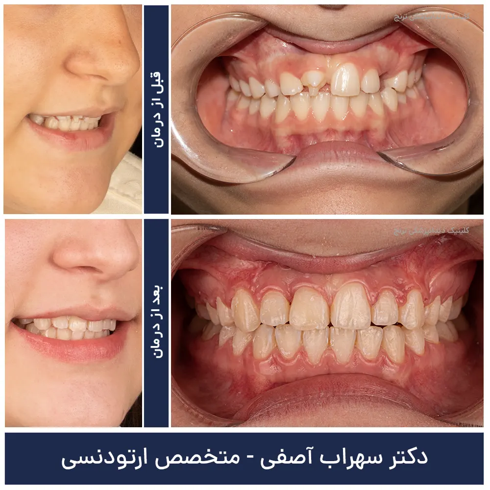 قبل و بعد درمان ارتودنسی