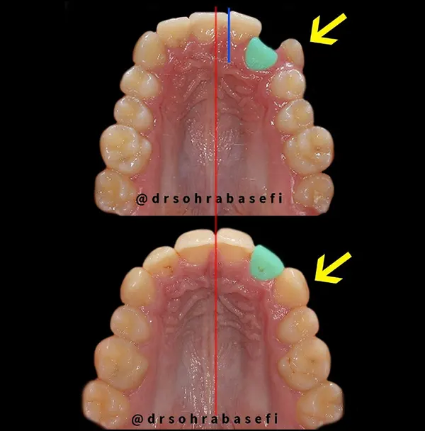 اصلاح کراس بایت (عقب بودن) دندان ثنایای چپ بالا با درمان ارتودنسی همراه با کشیدن دندان‌های آسیای کوچک
