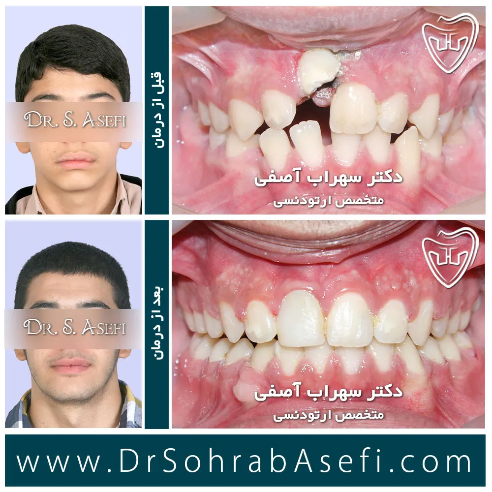قبل و بعد درمان ارتودنسی