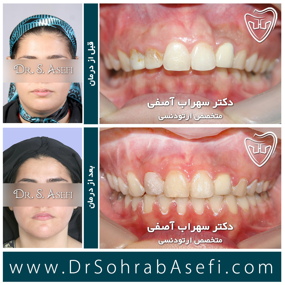 عکس قبل و بعد درمان ارتودنسی - دکتر سهراب آصفی