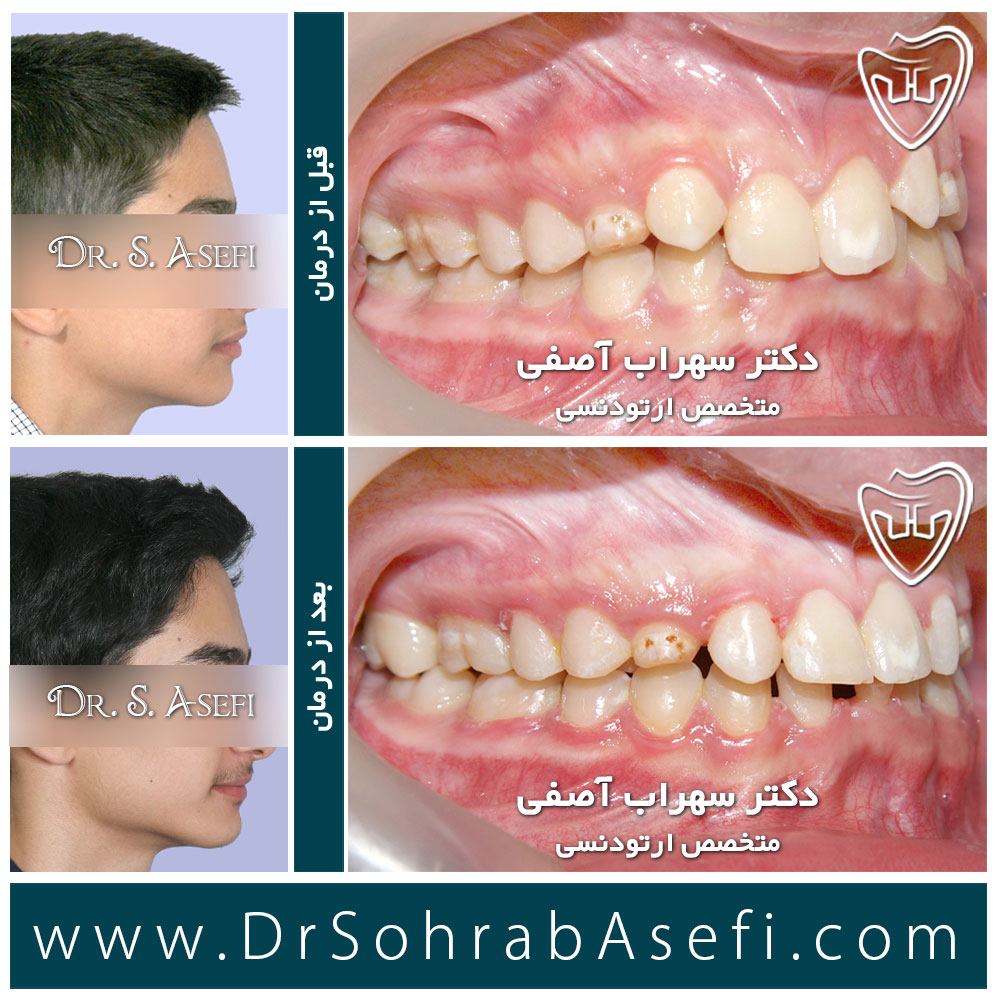 عکس قبل و بعد درمان ارتودنسی - دکتر سهراب آصفی