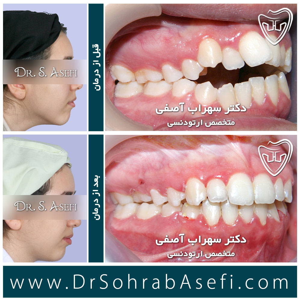 قبل و بعد از ارتودنسی دندان 