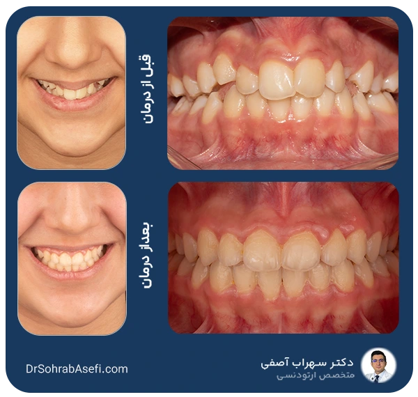 عکس قبل و بعد درمان ارتودنسی با دکتر سهراب آصفی