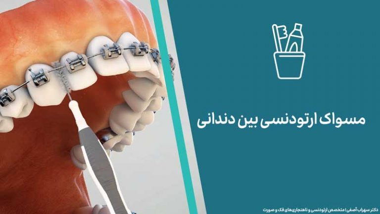 مسواک ارتودنسی بین دندانی