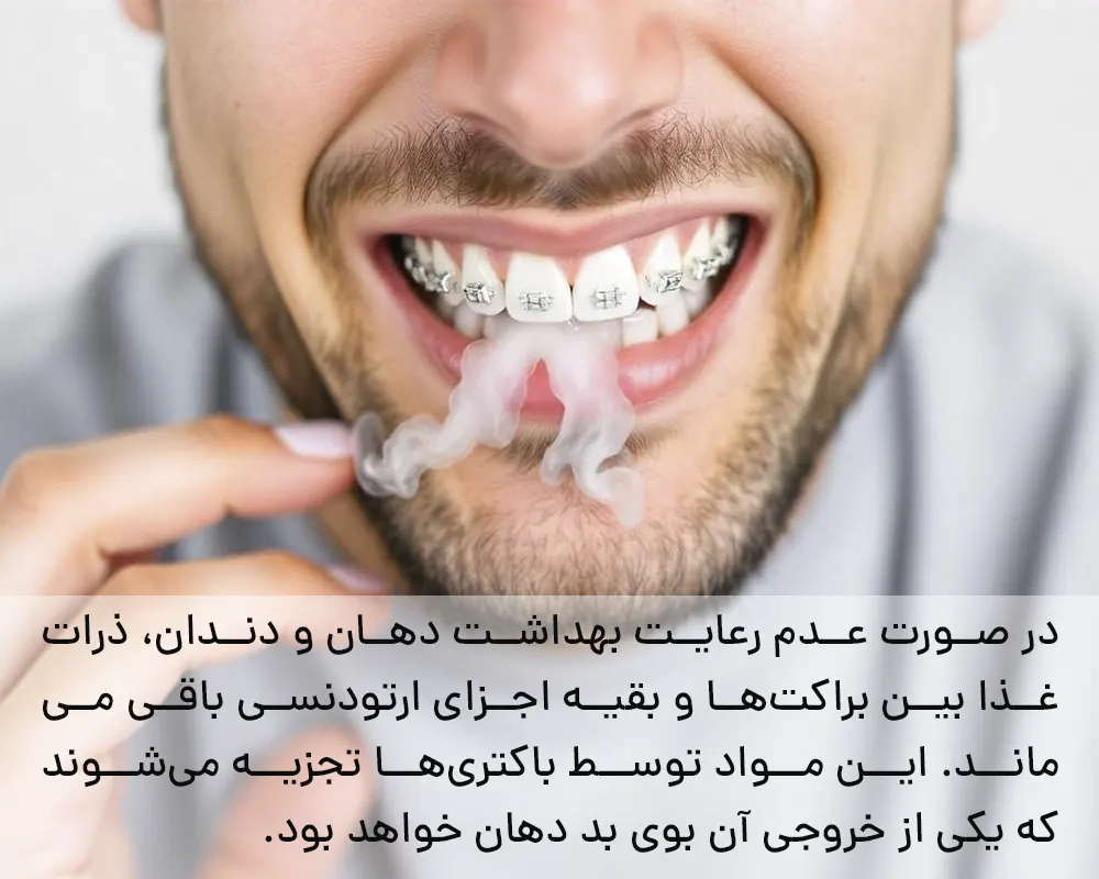 دلیل بوی بد دهان طی درمان ارتودنسی