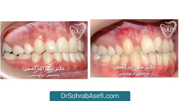 عکس قبل و بعد ارتودنسی