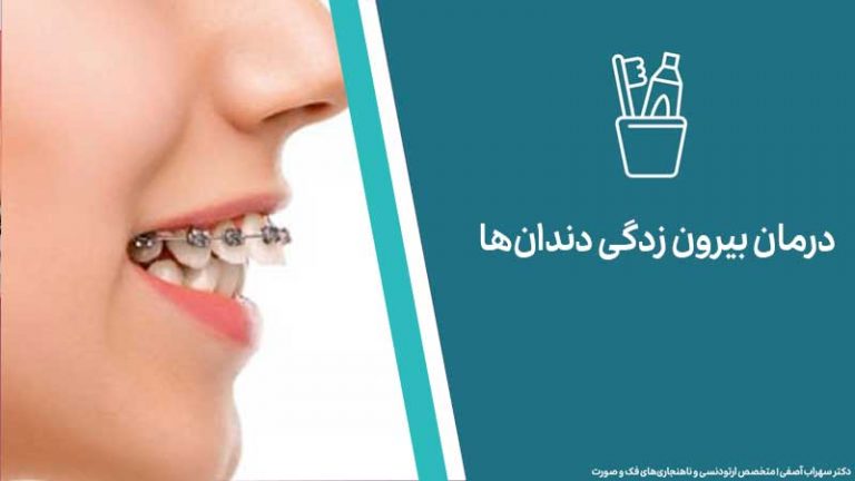 درمان بیرون زدگی دندان