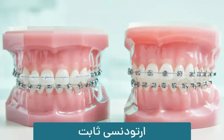 ارتودنسی ثابت