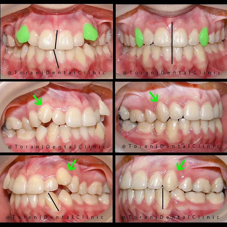 درمان ارتودنسی همراه با کشیدن دندان