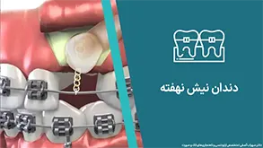 درمان دندان نیش نهفته