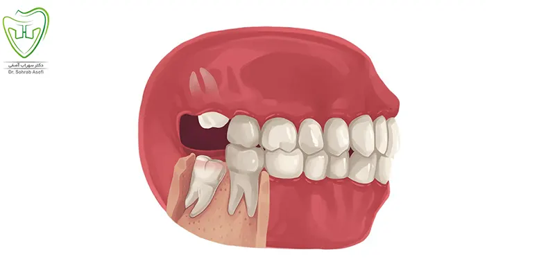 آیا برای ارتودنسی نیاز به کشیدن دندان عقل است؟